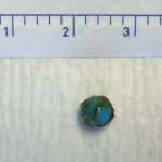 Bead removed from inside the ear
