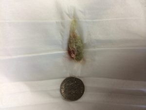 Cotton removed from an ear