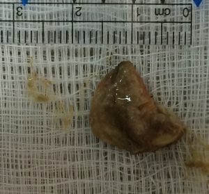 nasal foreign body