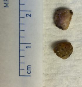 multiple rocks found in an ear