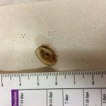 67 year old male foreign body