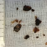 Cerumen