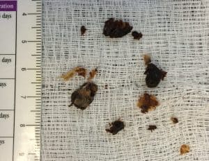 Tiny pieces of sticky, gooey substances, likely gum or chewing gum, scattered on a white mesh surface with a ruler for size reference, emphasizing safety and caution for children.