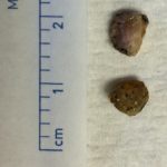 multiple rocks found in an ear