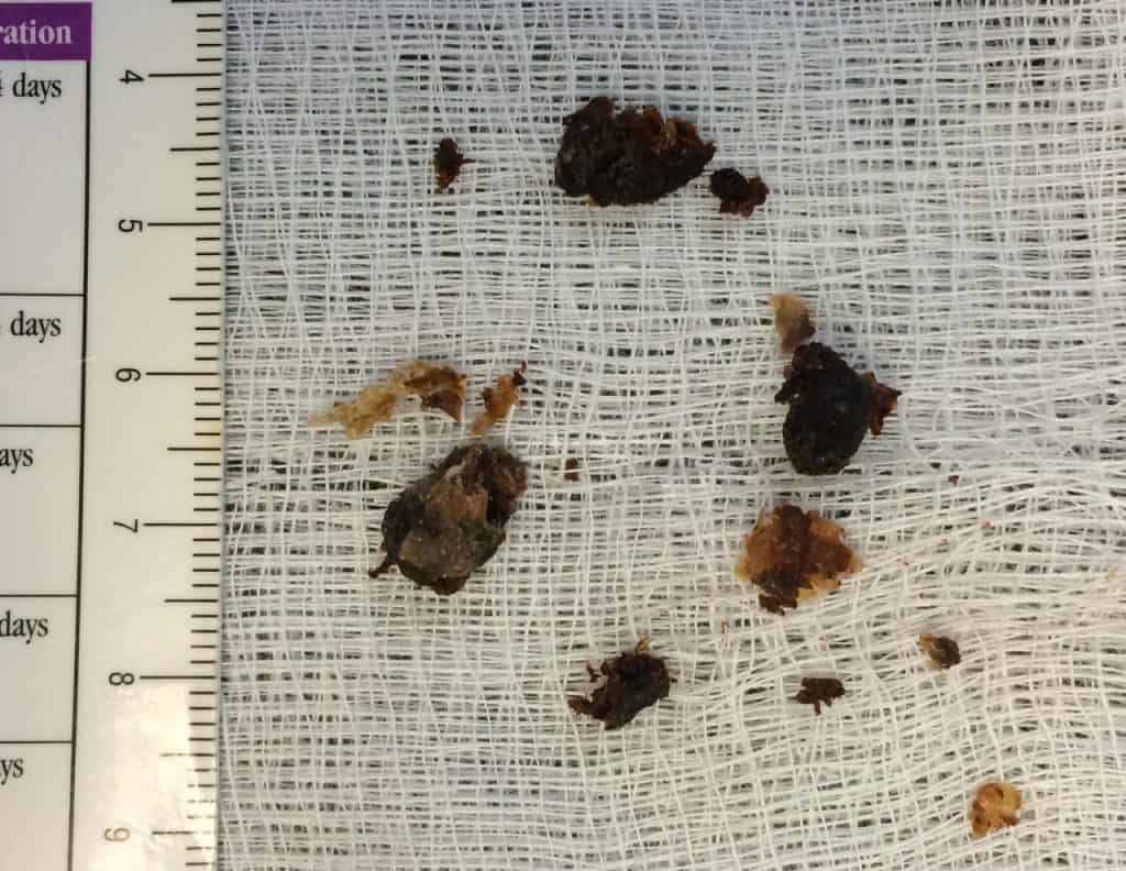 Tiny pieces of sticky, gooey substances, likely gum or chewing gum, scattered on a white mesh surface with a ruler for size reference, emphasizing safety and caution for children.
